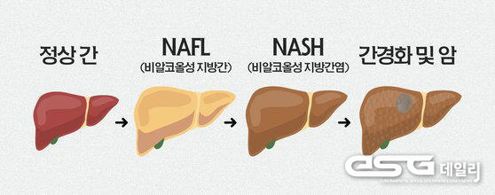 정상간과 지방간 이미지 비교. 지방간→지방간염→간경화 혹은 간암의 순서로 악화한다. 